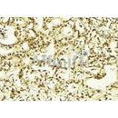 AF0239 at 1/100 staining Human breast cancer tissue by IHC-P. The sample was formaldehyde fixed and a heat mediated antigen retrieval step in citrate buffer was performed. The sample was then blocked and incubated with the antibody for 1.5 hours at 22¡ãC. An HRP conjugated goat anti-rabbit antibody was used as the secondary