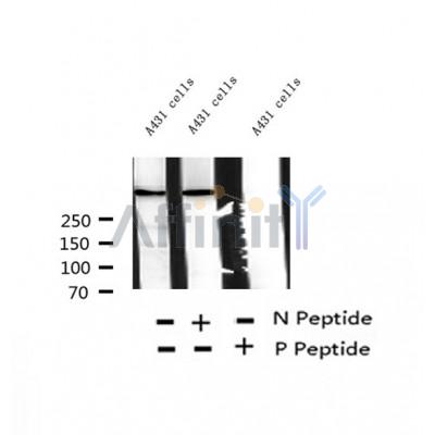 AF2303 at 1/100 staining Human thyroid cancer tissue by IHC-P. The sample was formaldehyde fixed and a heat mediated antigen retrieval step in citrate buffer was performed. The sample was then blocked and incubated with the antibody for 1.5 hours at 22¡ãC. An HRP conjugated goat anti-rabbit antibody was used as the secondary