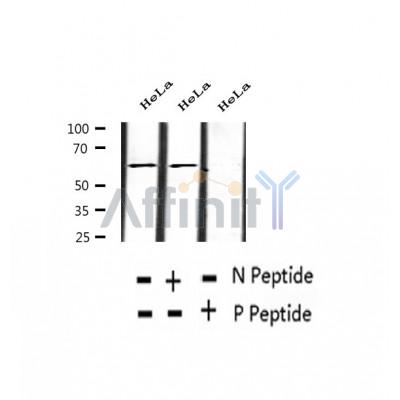 AF2333 at 1/100 staining Human thyroid cancer tissue by IHC-P. The sample was formaldehyde fixed and a heat mediated antigen retrieval step in citrate buffer was performed. The sample was then blocked and incubated with the antibody for 1.5 hours at 22¡ãC. An HRP conjugated goat anti-rabbit antibody was used as the secondary