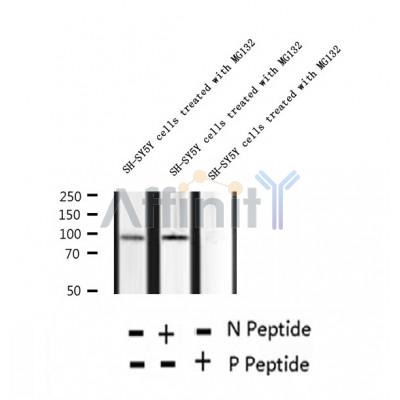 AF2343 at 1/100 staining Human breast cancer tissue by IHC-P. The sample was formaldehyde fixed and a heat mediated antigen retrieval step in citrate buffer was performed. The sample was then blocked and incubated with the antibody for 1.5 hours at 22¡ãC. An HRP conjugated goat anti-rabbit antibody was used as the secondary