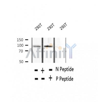 AF2344 at 1/100 staining Human breast cancer tissue by IHC-P. The sample was formaldehyde fixed and a heat mediated antigen retrieval step in citrate buffer was performed. The sample was then blocked and incubated with the antibody for 1.5 hours at 22¡ãC. An HRP conjugated goat anti-rabbit antibody was used as the secondary