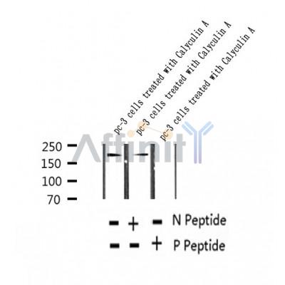 AF2357 at 1/100 staining Human thyroid cancer tissue by IHC-P. The sample was formaldehyde fixed and a heat mediated antigen retrieval step in citrate buffer was performed. The sample was then blocked and incubated with the antibody for 1.5 hours at 22¡ãC. An HRP conjugated goat anti-rabbit antibody was used as the secondary