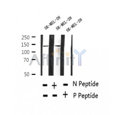 AF2370 at 1/100 staining Human thyroid cancer tissue by IHC-P. The sample was formaldehyde fixed and a heat mediated antigen retrieval step in citrate buffer was performed. The sample was then blocked and incubated with the antibody for 1.5 hours at 22¡ãC. An HRP conjugated goat anti-rabbit antibody was used as the secondary
