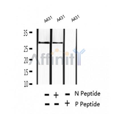 AF2393 at 1/100 staining Human thyroid cancer tissue by IHC-P. The sample was formaldehyde fixed and a heat mediated antigen retrieval step in citrate buffer was performed. The sample was then blocked and incubated with the antibody for 1.5 hours at 22¡ãC. An HRP conjugated goat anti-rabbit antibody was used as the secondary