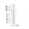 AF2407 at 1/100 staining Human breast cancer tissue by IHC-P. The sample was formaldehyde fixed and a heat mediated antigen retrieval step in citrate buffer was performed. The sample was then blocked and incubated with the antibody for 1.5 hours at 22¡ãC. An HRP conjugated goat anti-rabbit antibody was used as the secondary