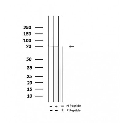 AF2407 at 1/100 staining Human breast cancer tissue by IHC-P. The sample was formaldehyde fixed and a heat mediated antigen retrieval step in citrate buffer was performed. The sample was then blocked and incubated with the antibody for 1.5 hours at 22¡ãC. An HRP conjugated goat anti-rabbit antibody was used as the secondary