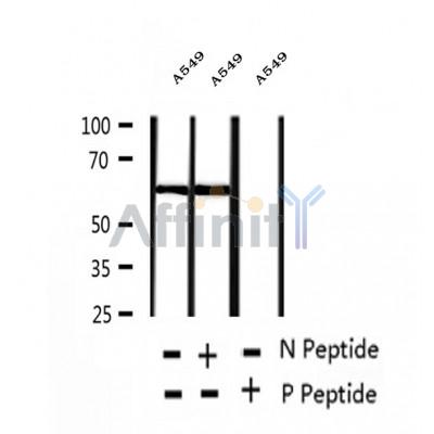 AF2411 at 1/100 staining Human breast cancer tissue by IHC-P. The sample was formaldehyde fixed and a heat mediated antigen retrieval step in citrate buffer was performed. The sample was then blocked and incubated with the antibody for 1.5 hours at 22¡ãC. An HRP conjugated goat anti-rabbit antibody was used as the secondary