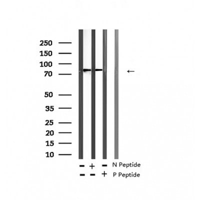 AF2418 at 1/100 staining Human thyroid cancer tissue by IHC-P. The sample was formaldehyde fixed and a heat mediated antigen retrieval step in citrate buffer was performed. The sample was then blocked and incubated with the antibody for 1.5 hours at 22¡ãC. An HRP conjugated goat anti-rabbit antibody was used as the secondary