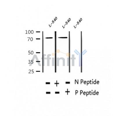 AF2426 at 1/100 staining Human thyroid cancer tissue by IHC-P. The sample was formaldehyde fixed and a heat mediated antigen retrieval step in citrate buffer was performed. The sample was then blocked and incubated with the antibody for 1.5 hours at 22¡ãC. An HRP conjugated goat anti-rabbit antibody was used as the secondary