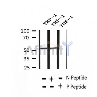 AF2428 at 1/100 staining Human thyroid cancer tissue by IHC-P. The sample was formaldehyde fixed and a heat mediated antigen retrieval step in citrate buffer was performed. The sample was then blocked and incubated with the antibody for 1.5 hours at 22¡ãC. An HRP conjugated goat anti-rabbit antibody was used as the secondary