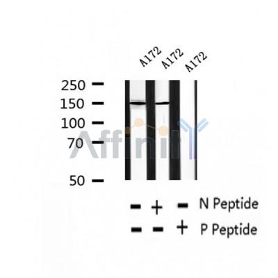 AF2432 at 1/100 staining Human thyroid cancer tissue by IHC-P. The sample was formaldehyde fixed and a heat mediated antigen retrieval step in citrate buffer was performed. The sample was then blocked and incubated with the antibody for 1.5 hours at 22¡ãC. An HRP conjugated goat anti-rabbit antibody was used as the secondary