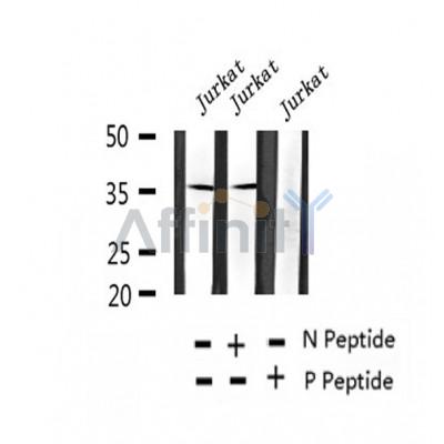 AF2441 at 1/100 staining Human breast cancer tissue by IHC-P. The sample was formaldehyde fixed and a heat mediated antigen retrieval step in citrate buffer was performed. The sample was then blocked and incubated with the antibody for 1.5 hours at 22¡ãC. An HRP conjugated goat anti-rabbit antibody was used as the secondary