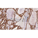 AF0014 at 1/100 staining Human thyroid cancer tissue by IHC-P. The sample was formaldehyde fixed and a heat mediated antigen retrieval step in citrate buffer was performed. The sample was then blocked and incubated with the antibody for 1.5 hours at 22¡ãC. An HRP conjugated goat anti-rabbit antibody was used as the secondary