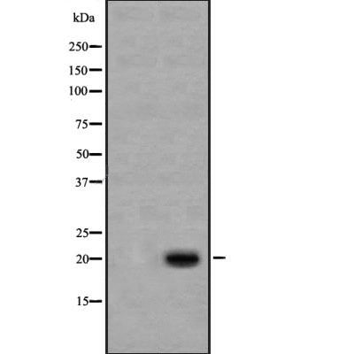 AF4005 at 1/100 staining Human thyroid cancer tissue by IHC-P. The sample was formaldehyde fixed and a heat mediated antigen retrieval step in citrate buffer was performed. The sample was then blocked and incubated with the antibody for 1.5 hours at 22¡ãC. An HRP conjugated goat anti-rabbit antibody was used as the secondary