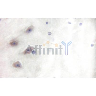 AF3459 at 1/100 staining Human breast cancer tissue by IHC-P. The sample was formaldehyde fixed and a heat mediated antigen retrieval step in citrate buffer was performed. The sample was then blocked and incubated with the antibody for 1.5 hours at 22¡ãC. An HRP conjugated goat anti-rabbit antibody was used as the secondary