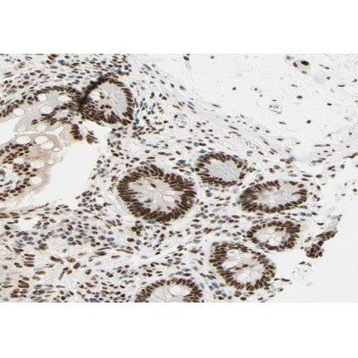 AF0248 at 1/100 staining human colon carcinoma tissue sections by IHC-P. The tissue was formaldehyde fixed and a heat mediated antigen retrieval step in citrate buffer was performed. The tissue was then blocked and incubated with the antibody for 1.5 hours at 22¡ãC. An HRP conjugated goat anti-rabbit antibody was used as the secondary