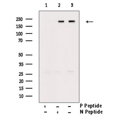 AF3489 at 1/100 staining Human liver cancer tissue by IHC-P. The sample was formaldehyde fixed and a heat mediated antigen retrieval step in citrate buffer was performed. The sample was then blocked and incubated with the antibody for 1.5 hours at 22¡ãC. An HRP conjugated goat anti-rabbit antibody was used as the secondary
