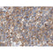 AF0256 at 1/100 staining human lung carcinoma tissue sections by IHC-P. The tissue was formaldehyde fixed and a heat mediated antigen retrieval step in citrate buffer was performed. The tissue was then blocked and incubated with the antibody for 1.5 hours at 22¡ãC. An HRP conjugated goat anti-rabbit antibody was used as the secondary