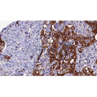 AF0257 at 1/100 staining Human Head and neck cancer tissue by IHC-P. The sample was formaldehyde fixed and a heat mediated antigen retrieval step in citrate buffer was performed. The sample was then blocked and incubated with the antibody for 1.5 hours at 22¡ãC. An HRP conjugated goat anti-rabbit antibody was used as the secondary