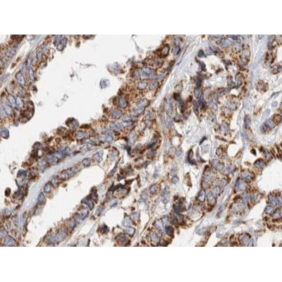 AF0258 at 1/100 staining human breast carcinoma tissue sections by IHC-P. The tissue was formaldehyde fixed and a heat mediated antigen retrieval step in citrate buffer was performed. The tissue was then blocked and incubated with the antibody for 1.5 hours at 22¡ãC. An HRP conjugated goat anti-rabbit antibody was used as the secondary