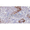 AF0262 at 1/100 staining Human urothelial cancer tissue by IHC-P. The sample was formaldehyde fixed and a heat mediated antigen retrieval step in citrate buffer was performed. The sample was then blocked and incubated with the antibody for 1.5 hours at 22¡ãC. An HRP conjugated goat anti-rabbit antibody was used as the secondary