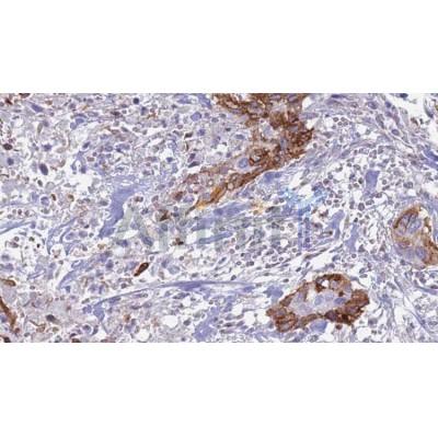 AF0262 at 1/100 staining Human urothelial cancer tissue by IHC-P. The sample was formaldehyde fixed and a heat mediated antigen retrieval step in citrate buffer was performed. The sample was then blocked and incubated with the antibody for 1.5 hours at 22¡ãC. An HRP conjugated goat anti-rabbit antibody was used as the secondary