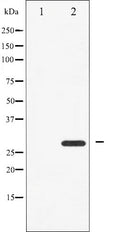 AF6208 at 1/100 staining Human breast cancer tissue by IHC-P. The sample was formaldehyde fixed and a heat mediated antigen retrieval step in citrate buffer was performed. The sample was then blocked and incubated with the antibody for 1.5 hours at 22¡ãC. An HRP conjugated goat anti-rabbit antibody was used as the secondary