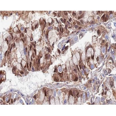 AF0276 at 1/100 staining human lung carcinoma tissue sections by IHC-P. The tissue was formaldehyde fixed and a heat mediated antigen retrieval step in citrate buffer was performed. The tissue was then blocked and incubated with the antibody for 1.5 hours at 22¡ãC. An HRP conjugated goat anti-rabbit antibody was used as the secondary