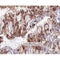 AF0276 at 1/100 staining human lung carcinoma tissue sections by IHC-P. The tissue was formaldehyde fixed and a heat mediated antigen retrieval step in citrate buffer was performed. The tissue was then blocked and incubated with the antibody for 1.5 hours at 22¡ãC. An HRP conjugated goat anti-rabbit antibody was used as the secondary