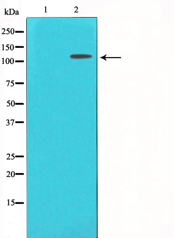 AF6291 at 1/100 staining Human urothelial cancer tissue by IHC-P. The sample was formaldehyde fixed and a heat mediated antigen retrieval step in citrate buffer was performed. The sample was then blocked and incubated with the antibody for 1.5 hours at 22¡ãC. An HRP conjugated goat anti-rabbit antibody was used as the secondary
