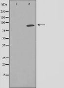 AF6305 at 1/100 staining Human breast cancer tissue by IHC-P. The sample was formaldehyde fixed and a heat mediated antigen retrieval step in citrate buffer was performed. The sample was then blocked and incubated with the antibody for 1.5 hours at 22¡ãC. An HRP conjugated goat anti-rabbit antibody was used as the secondary