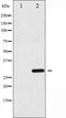AF6333 at 1/100 staining Human breast cancer tissue by IHC-P. The sample was formaldehyde fixed and a heat mediated antigen retrieval step in citrate buffer was performed. The sample was then blocked and incubated with the antibody for 1.5 hours at 22¡ãC. An HRP conjugated goat anti-rabbit antibody was used as the secondary