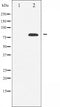 AF6395 at 1/100 staining Human breast cancer tissue by IHC-P. The sample was formaldehyde fixed and a heat mediated antigen retrieval step in citrate buffer was performed. The sample was then blocked and incubated with the antibody for 1.5 hours at 22¡ãC. An HRP conjugated goat anti-rabbit antibody was used as the secondary