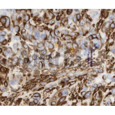 AF0292 at 1/100 staining Human breast cancer tissue by IHC-P. The sample was formaldehyde fixed and a heat mediated antigen retrieval step in citrate buffer was performed. The sample was then blocked and incubated with the antibody for 1.5 hours at 22¡ãC. An HRP conjugated goat anti-rabbit antibody was used as the secondary