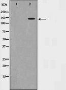 AF6439 at 1/100 staining Human breast cancer tissue by IHC-P. The sample was formaldehyde fixed and a heat mediated antigen retrieval step in citrate buffer was performed. The sample was then blocked and incubated with the antibody for 1.5 hours at 22¡ãC. An HRP conjugated goat anti-rabbit antibody was used as the secondary