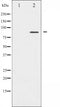 AF6441 at 1/100 staining Human breast cancer tissue by IHC-P. The sample was formaldehyde fixed and a heat mediated antigen retrieval step in citrate buffer was performed. The sample was then blocked and incubated with the antibody for 1.5 hours at 22¡ãC. An HRP conjugated goat anti-rabbit antibody was used as the secondary