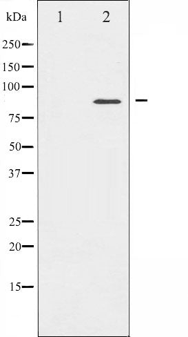 AF6441 at 1/100 staining Human breast cancer tissue by IHC-P. The sample was formaldehyde fixed and a heat mediated antigen retrieval step in citrate buffer was performed. The sample was then blocked and incubated with the antibody for 1.5 hours at 22¡ãC. An HRP conjugated goat anti-rabbit antibody was used as the secondary