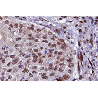 AF0298 at 1/100 staining human lung carcinoma tissue sections by IHC-P. The tissue was formaldehyde fixed and a heat mediated antigen retrieval step in citrate buffer was performed. The tissue was then blocked and incubated with the antibody for 1.5 hours at 22¡ãC. An HRP conjugated goat anti-rabbit antibody was used as the secondary