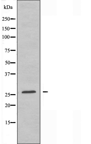 DF3292 at 1/100 staining Human breast cancer tissue by IHC-P. The sample was formaldehyde fixed and a heat mediated antigen retrieval step in citrate buffer was performed. The sample was then blocked and incubated with the antibody for 1.5 hours at 22¡ãC. An HRP conjugated goat anti-rabbit antibody was used as the secondary