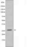 DF3292 at 1/100 staining Human breast cancer tissue by IHC-P. The sample was formaldehyde fixed and a heat mediated antigen retrieval step in citrate buffer was performed. The sample was then blocked and incubated with the antibody for 1.5 hours at 22¡ãC. An HRP conjugated goat anti-rabbit antibody was used as the secondary