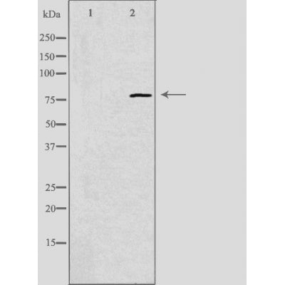 DF3367 at 1/100 staining Human urothelial cancer tissue by IHC-P. The sample was formaldehyde fixed and a heat mediated antigen retrieval step in citrate buffer was performed. The sample was then blocked and incubated with the antibody for 1.5 hours at 22¡ãC. An HRP conjugated goat anti-rabbit antibody was used as the secondary