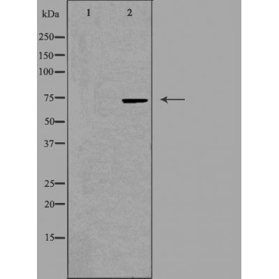 DF3388 at 1/100 staining Human breast cancer tissue by IHC-P. The sample was formaldehyde fixed and a heat mediated antigen retrieval step in citrate buffer was performed. The sample was then blocked and incubated with the antibody for 1.5 hours at 22¡ãC. An HRP conjugated goat anti-rabbit antibody was used as the secondary