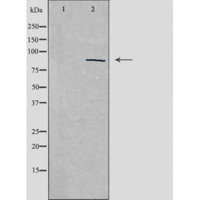 DF3476 at 1/100 staining Human breast cancer tissue by IHC-P. The sample was formaldehyde fixed and a heat mediated antigen retrieval step in citrate buffer was performed. The sample was then blocked and incubated with the antibody for 1.5 hours at 22¡ãC. An HRP conjugated goat anti-rabbit antibody was used as the secondary