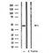 DF3497 at 1/100 staining Human liver cancer tissue by IHC-P. The sample was formaldehyde fixed and a heat mediated antigen retrieval step in citrate buffer was performed. The sample was then blocked and incubated with the antibody for 1.5 hours at 22¡ãC. An HRP conjugated goat anti-rabbit antibody was used as the secondary