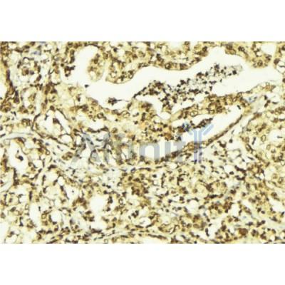 AF0358 at 1/100 staining Human breast cancer tissue by IHC-P. The sample was formaldehyde fixed and a heat mediated antigen retrieval step in citrate buffer was performed. The sample was then blocked and incubated with the antibody for 1.5 hours at 22¡ãC. An HRP conjugated goat anti-rabbit antibody was used as the secondary