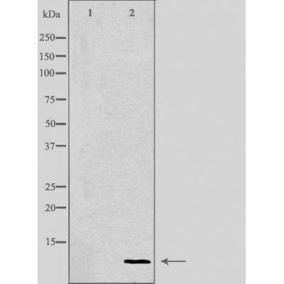 DF3558 at 1/100 staining Human breast cancer tissue by IHC-P. The sample was formaldehyde fixed and a heat mediated antigen retrieval step in citrate buffer was performed. The sample was then blocked and incubated with the antibody for 1.5 hours at 22¡ãC. An HRP conjugated goat anti-rabbit antibody was used as the secondary