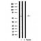 DF3564 at 1/100 staining Human brain cancer tissue by IHC-P. The sample was formaldehyde fixed and a heat mediated antigen retrieval step in citrate buffer was performed. The sample was then blocked and incubated with the antibody for 1.5 hours at 22¡ãC. An HRP conjugated goat anti-rabbit antibody was used as the secondary