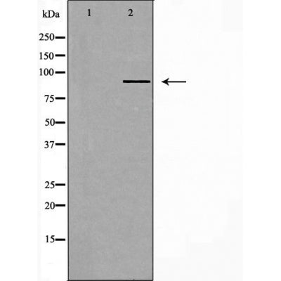 DF3575 at 1/100 staining Human cervical cancer tissue by IHC-P. The sample was formaldehyde fixed and a heat mediated antigen retrieval step in citrate buffer was performed. The sample was then blocked and incubated with the antibody for 1.5 hours at 22¡ãC. An HRP conjugated goat anti-rabbit antibody was used as the secondary
