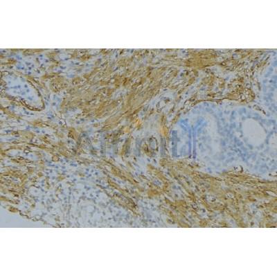 DF3595 staining Hela by IF/ICC. The sample were fixed with PFA and permeabilized in 0.1% Triton X-100,then blocked in 10% serum for 45 minutes at 25¡ãC. The primary antibody was diluted at 1/200 and incubated with the sample for 1 hour at 37¡ãC. An  Alexa Fluor 594 conjugated goat anti-rabbit IgG (H+L) Ab, diluted at 1/600, was used as the secondary antibod