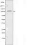 DF3639 at 1/100 staining Human breast cancer tissue by IHC-P. The sample was formaldehyde fixed and a heat mediated antigen retrieval step in citrate buffer was performed. The sample was then blocked and incubated with the antibody for 1.5 hours at 22¡ãC. An HRP conjugated goat anti-rabbit antibody was used as the secondary
